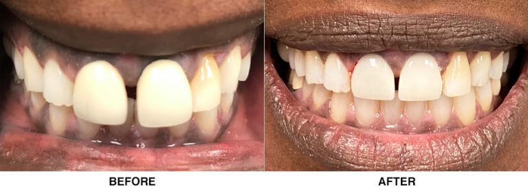 New esthetic crowns (Per her request, patient wanted a small space to remain)