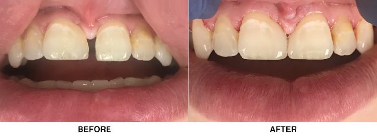 Esthetic bonding to close large space and restore asymmetry between front teeth
