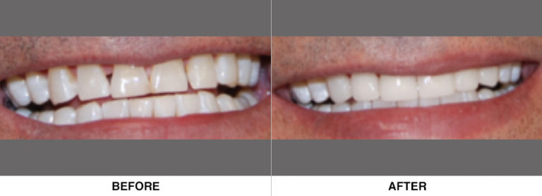 Veneers to close spaces and revitalize teeth and patient confidence