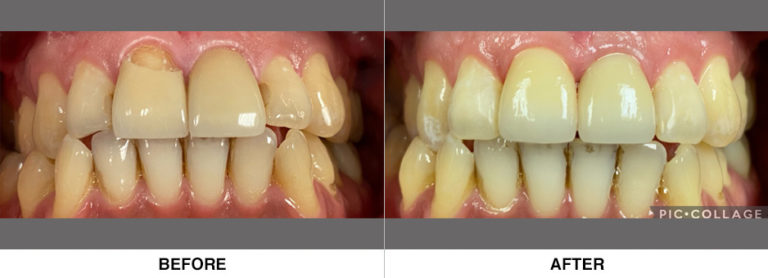 Combination of new esthetic crowns and esthetic bondings