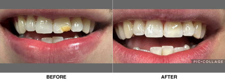 Cosmetic bonding of just the discolored left front tooth.