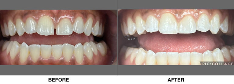 Invisalign and Cosmetic Bonding