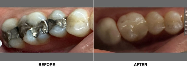 Bonded fillings & crown