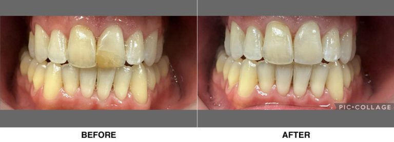 Esthetic bonding of left front tooth.