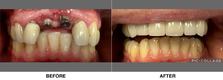 Full upper arch reconstruction. Patient had missing teeth and poorly sized crowns for 40+years!