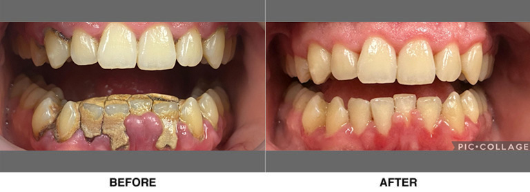 Deep cleaning, after 1 week of healing. The patient had a traumatic dental experience as a child that led him to stay away from getting dental care for over 12 years.