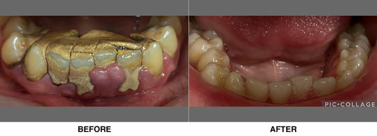 Deep cleaning, after 1 week of healing. The patient had a traumatic dental experience as a child that led him to stay away from getting dental care for over 12 years.
