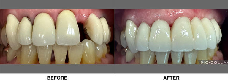 Bridgework leading to improved esthetics and replacing missing teeth