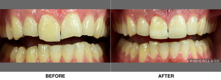 Esthetic bondings, restoring patient’s confidence and teeth broken from when he was bullied as a child.