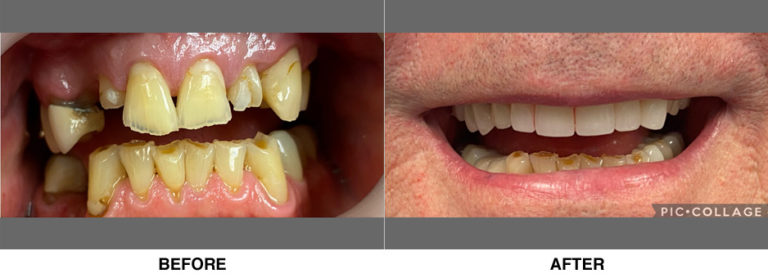 Crowns restoring patient’s smile and confidence, resolving over 40 years of deterioration.