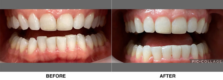 Invisalign treatment, resolving repeated chipping of front teeth