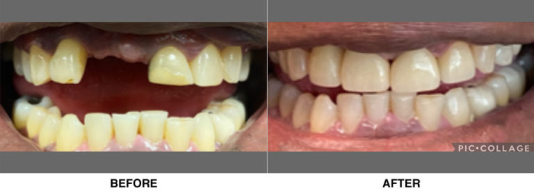 Bridge, crowns and veneers to restore where patient had been missing his front tooth for over 40 years.