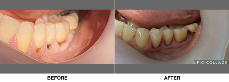 Dental bondings restoring deep root cavities after gum recession.