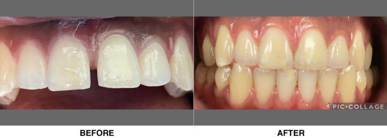 Esthetic bondings closing long-standing space between two front teeth.