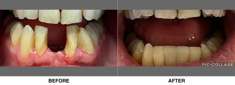 Bridge restoring two teeth lost due to a dental autoimmune condition.