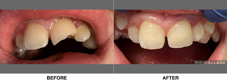 Esthetic bonding on a young boy after he tripped and broke his front tooth against concrete.