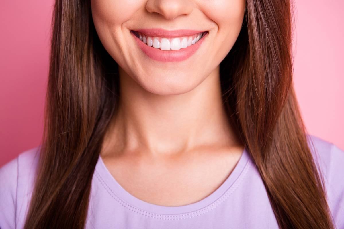 concept of veneers without missing teeth