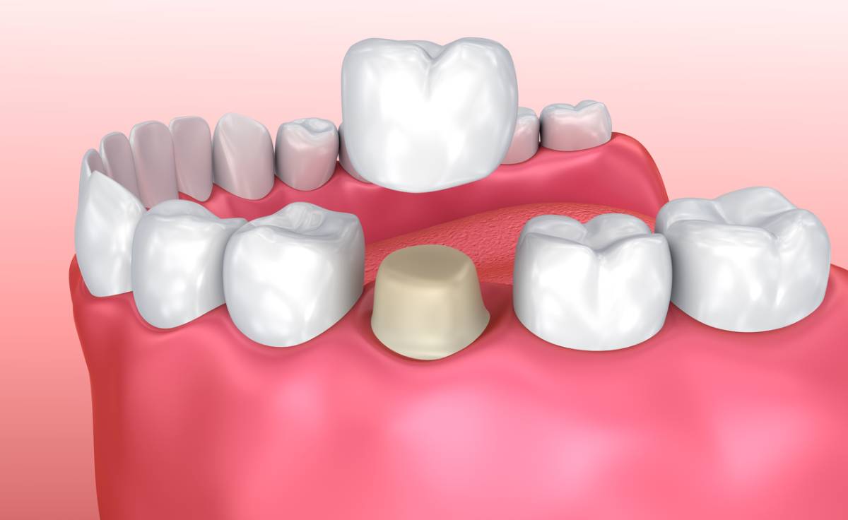 featured image for dental crowns get stained