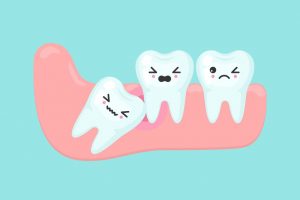 Wisdom tooth problems dental stomatology vector stock photo