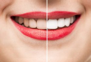 visual showing teeth whitening but not teeth cleaning really