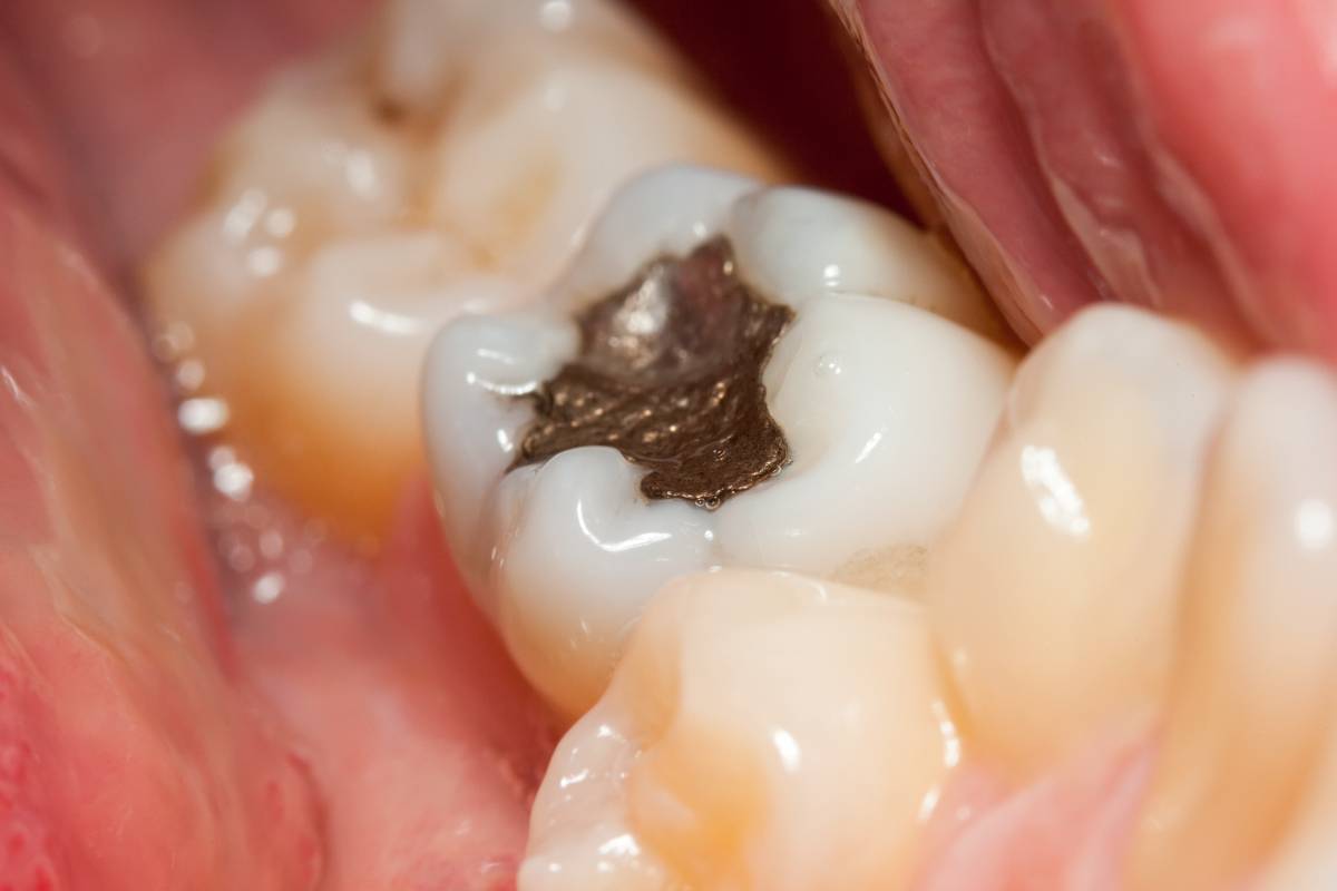 Featured image for What Does a Dental Filling Look Like