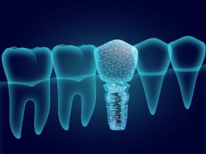 The image shows an x-ray style illustration of teeth and dental implant on dark blue background. It intends to show what to expect after getting dental crowns.