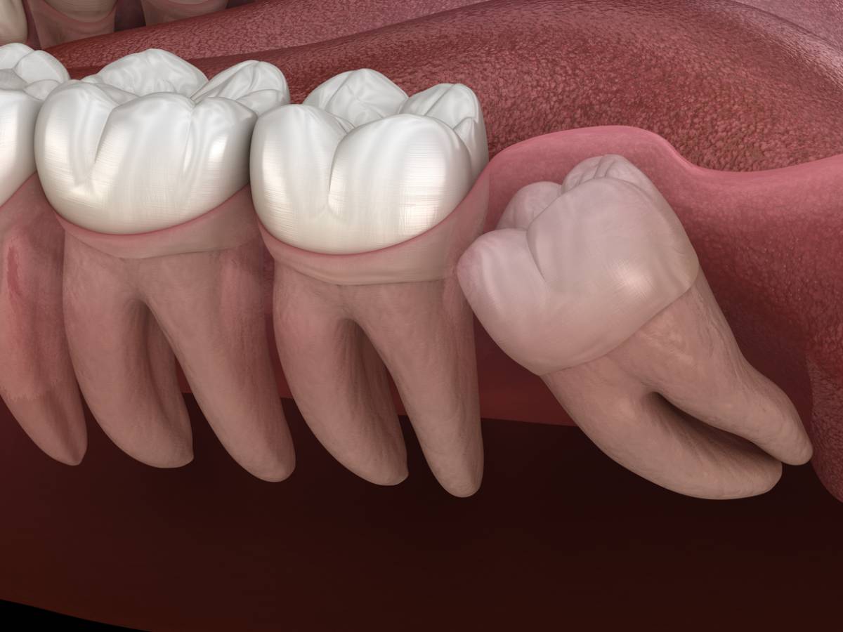 featured image for wisdom teeth issues after 40